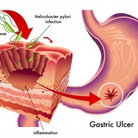 Гиперацидный гастрит – симптомы и лечение