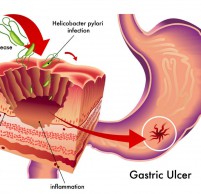 Гиперацидный гастрит – симптомы и лечение