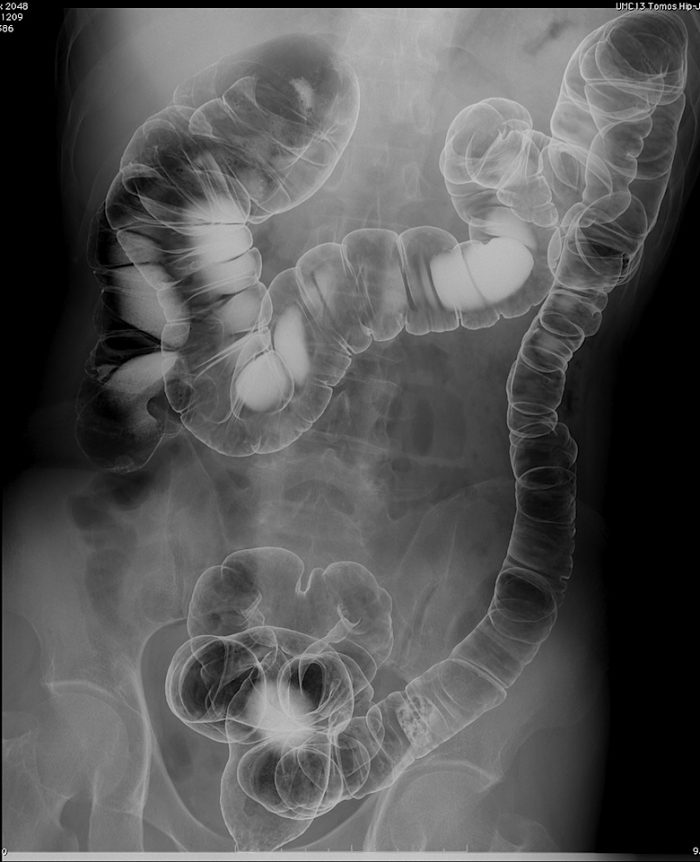 Рентгенография желудка с двойным контрастом