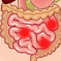 Полипы кишечника: симптомы и проявления данной болезни