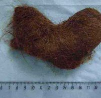 Волосы в желудке: проявления и лечение трихобезоара