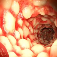 Дисбактериоз желудка: причины, симптомы и лечение