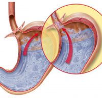 Недостаточность кардии желудка: причины, симптомы и лечение