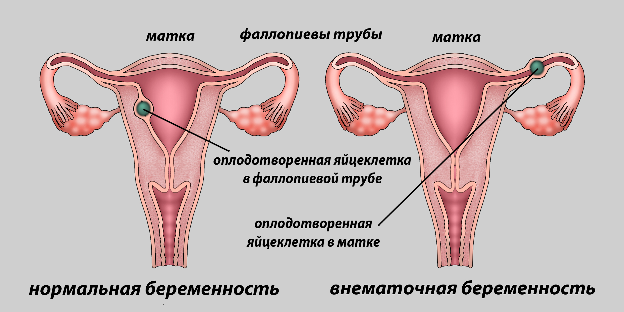 увеличивается ли грудь при внематочной беременности фото 4