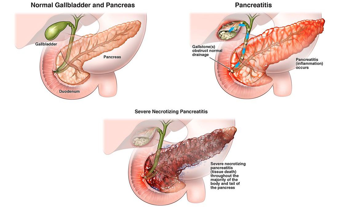 Se puede curar la pancreatitis