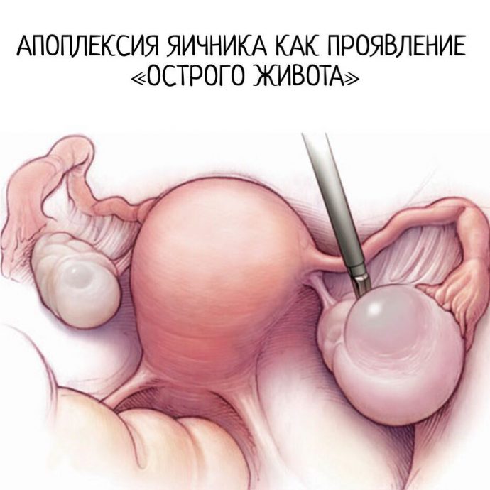 Апоплексия яичника