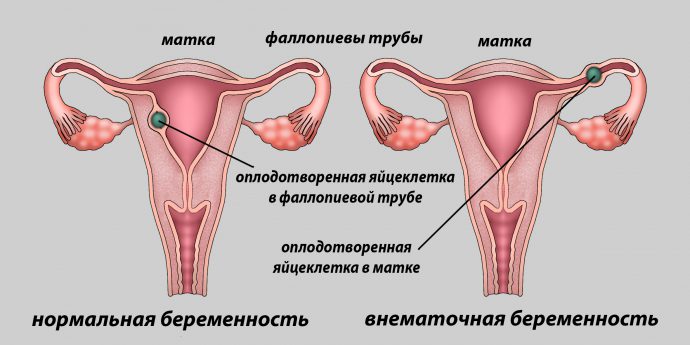 проявления внематочной беременности