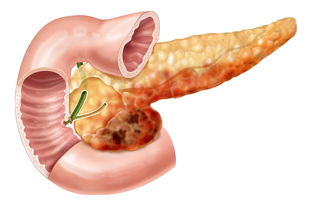 Некротический панкреонекроз поджелудочной железы