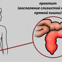 Проктит кишечника: симптомы и лечение