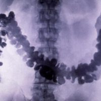 Подготовка к рентгену кишечника с барием