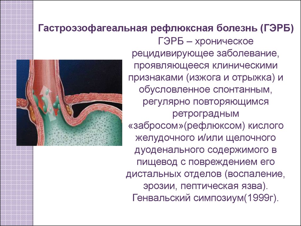 Желудочный сок в пищеводе. Презентация Гастроэзофагеальная рефлюксная болезнь у детей симптомы. Гастроэзофагеальный (желудочно-пищеводный) рефлюкс. Гастроэзофагеальнорефлюксная болезнь (ГЭРБ);. Эзофагеальная болезнь ( рефлюкс).