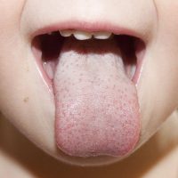 Причины появления жёлтого налёта на языке у ребёнка